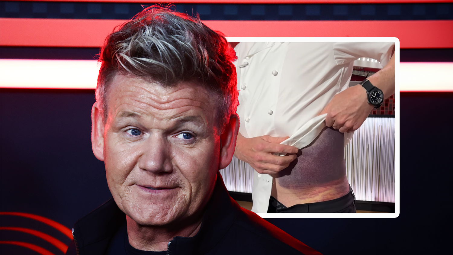 Bei einem Radfahrunfall zog sich Gordon Ramsay einen schweren Bluterguss zu.