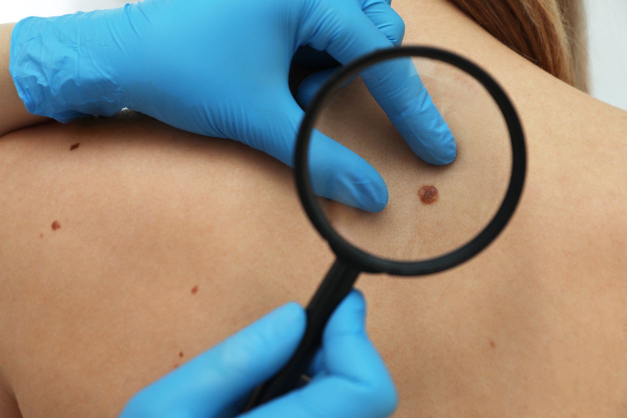 Um Hautkrebs zu verhindern, ist ein regelmäßiger Check beim Hautarzt Pflicht.