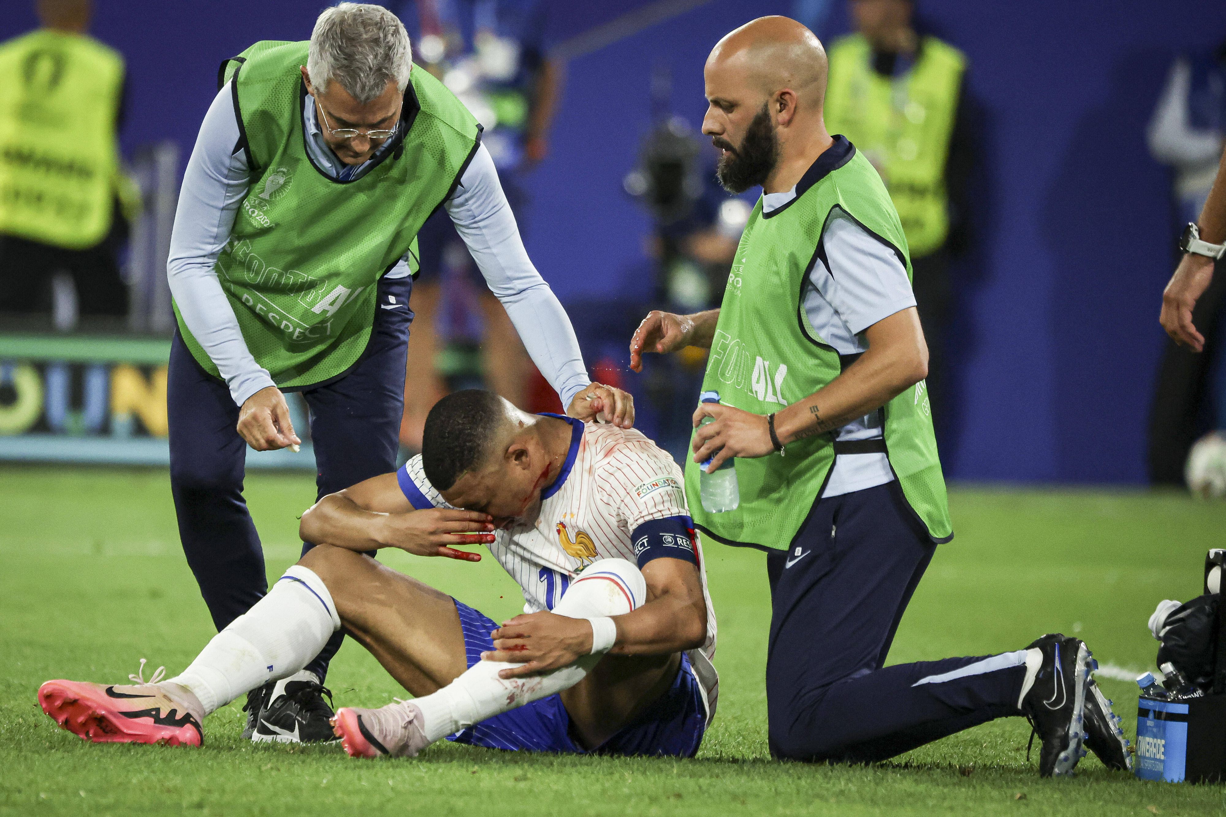 Mbappe brach sich gegen Danso die Nase.