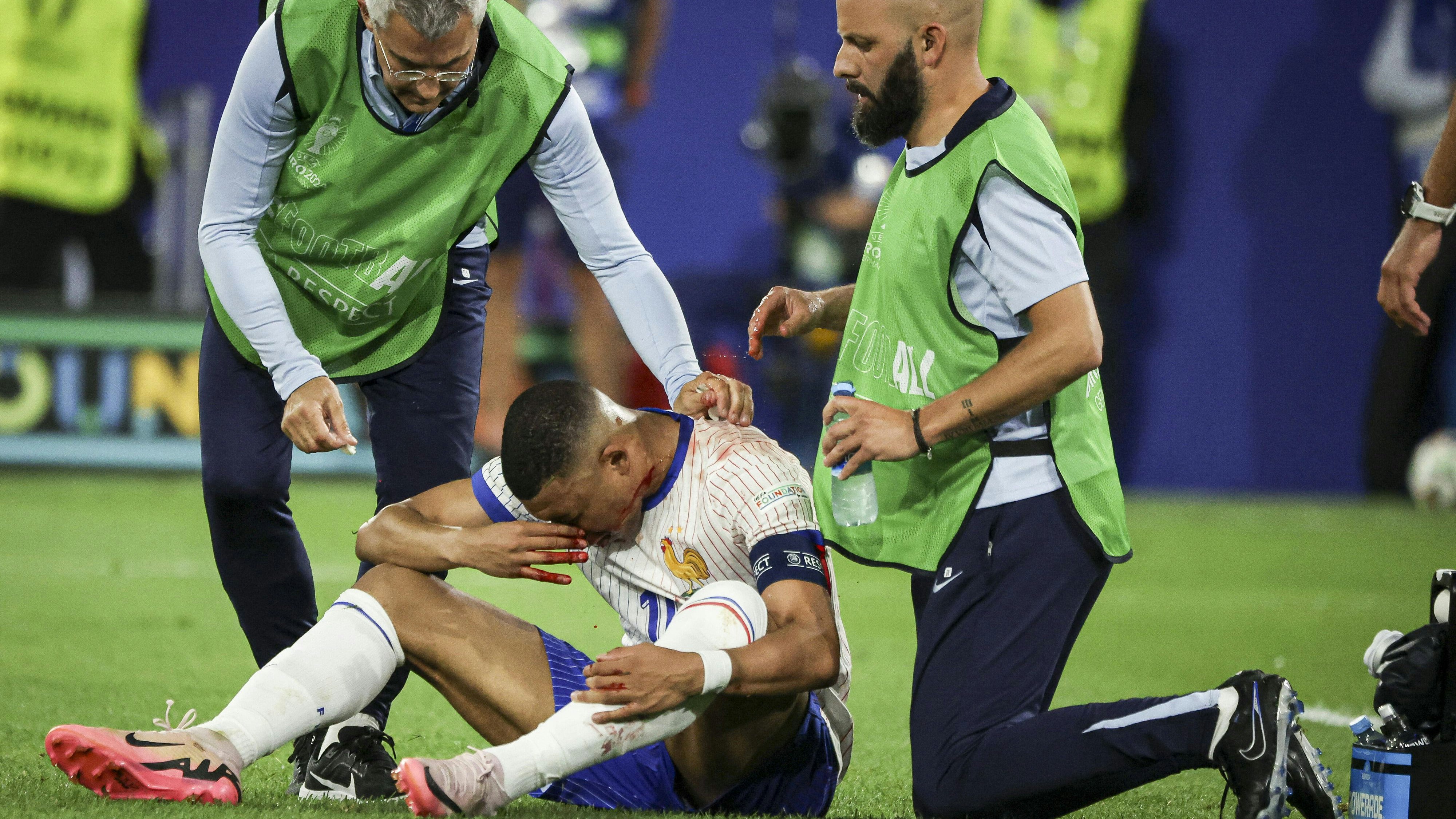 Mbappe brach sich gegen Danso die Nase.