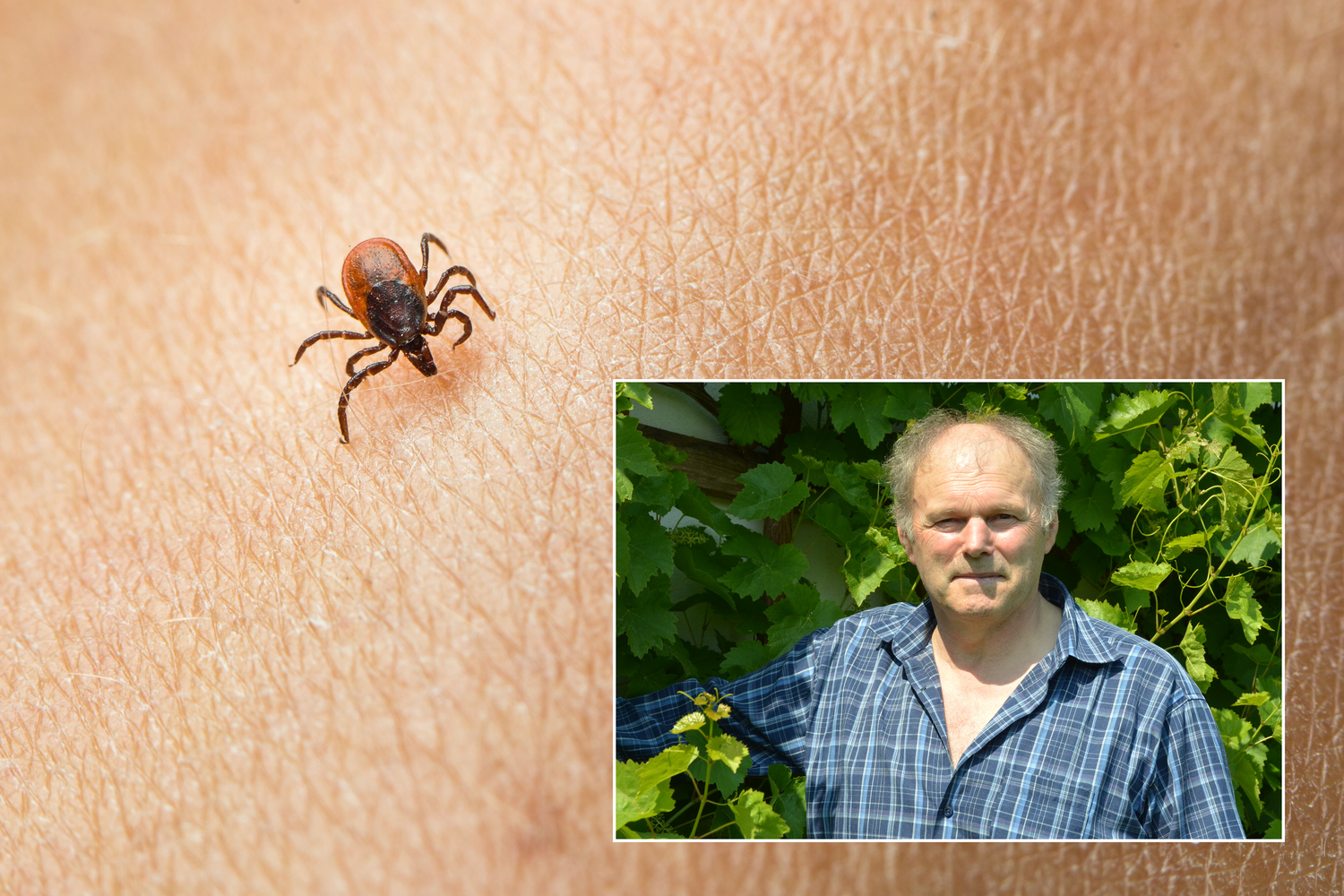 Der 72-Jährige hatte an einem Tag 16 Zeckenstiche.