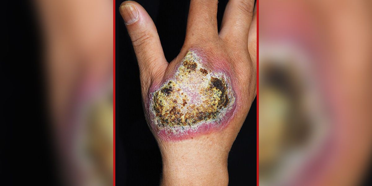 Mit einer riesigen Läsion (Bild) suchte der Mann ärztliche Hilfe auf.