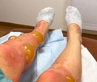 Riesige Blasen breiteten sich auf den Beinen von Mutter Anna Tanushi aus (siehe Bild).