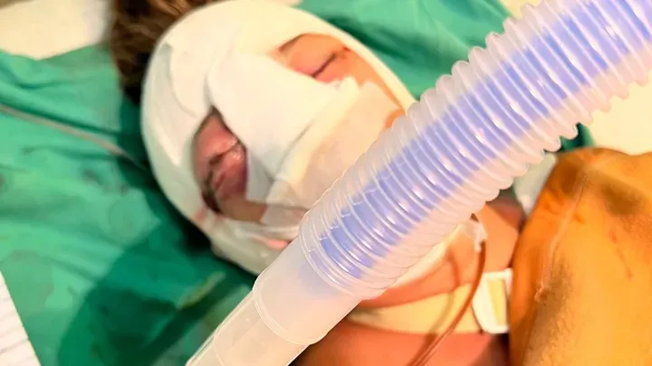 Sie erlitt mehrere Knochenbrüche im Gesicht und eine Gehirnblutung, ihre Augenhöhlen waren zertrümmert.