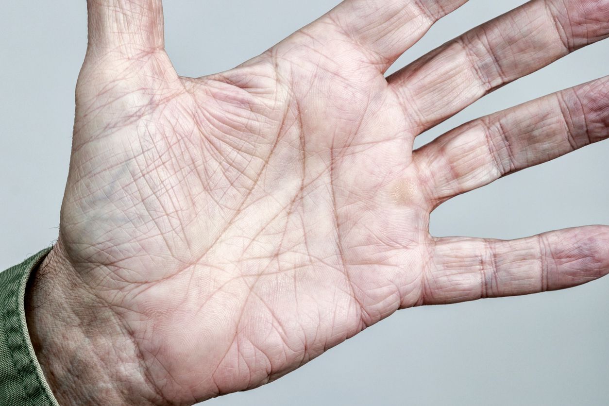 Die Paida-Lajin-Therapie soll durch das Schlagen von Menschen in verschiedenen Positionen Krankheiten und Beschwerden heilen, indem es den Körper entgiftet. (Symbolbild)