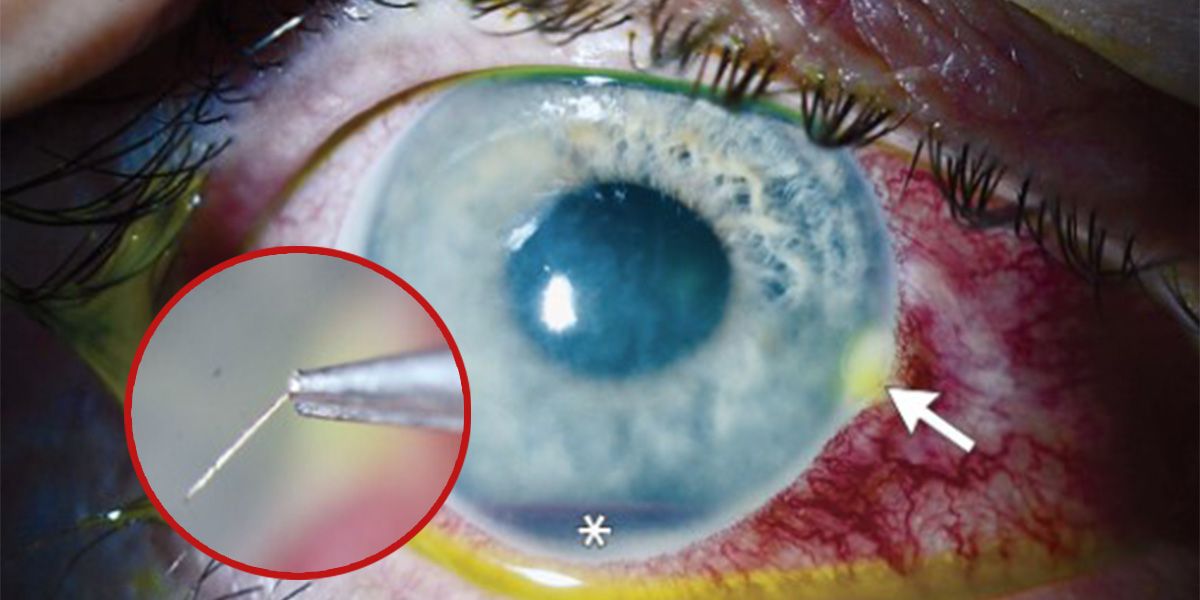 So sah das Auge des Mannes nach dem Stich aus. Der weiße Pfeil zeigt die Stelle, an der der Stachel (kl. Bild) eingebettet war.