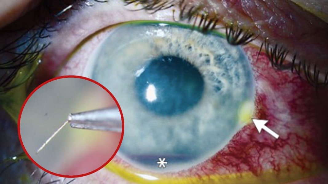 So sah das Auge des Mannes nach dem Stich aus. Der weiße Pfeil zeigt die Stelle, an der der Stachel eingebettet war.