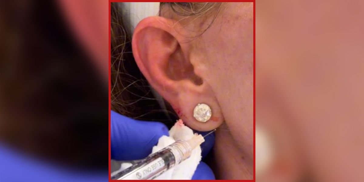 Wenige Sekunden dauert der Eingriff, bei dem ein Ohrläppchen mit Hyaluron wieder aufgefüllt wird.