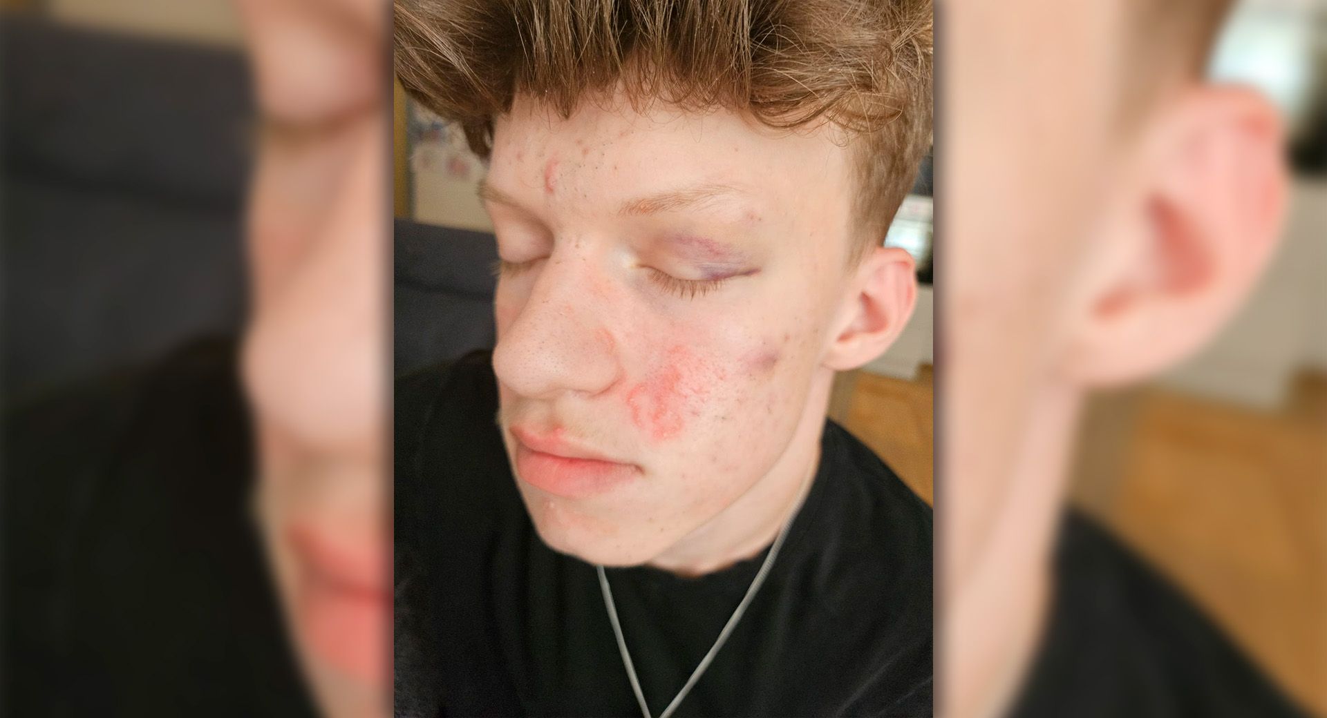 Marcel (18) nach der brutalen Attacke in der Leopoldstadt