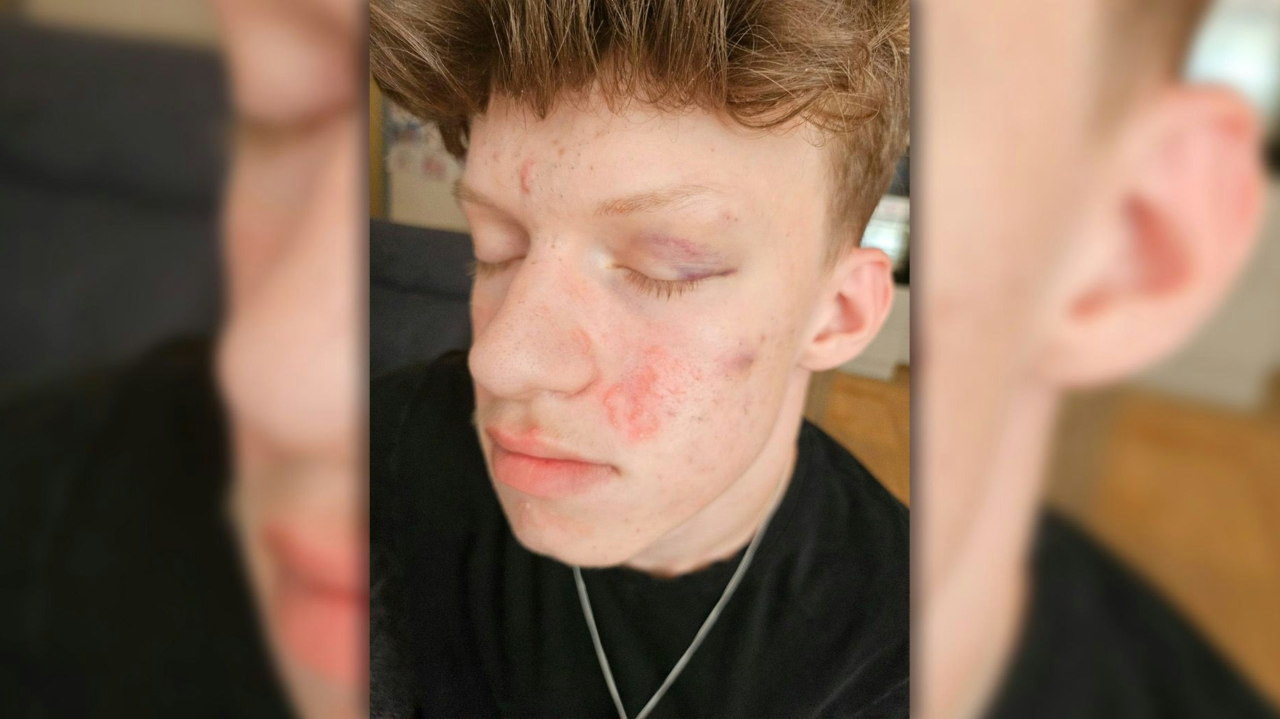 Marcel (18) nach der brutalen Attacke in der Leopoldstadt