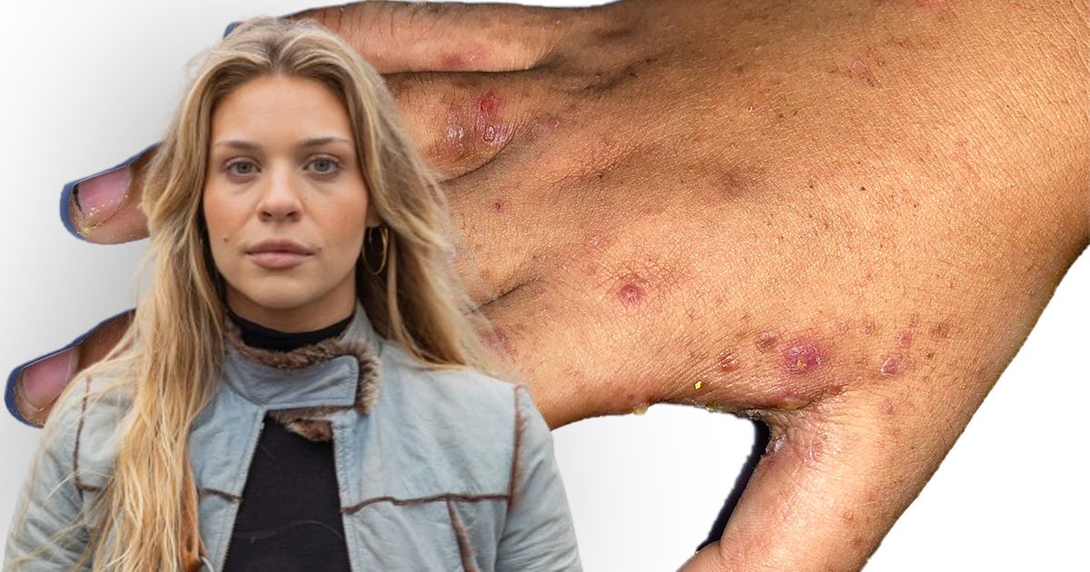 Anja Windl ist an der Krätze erkrankt. Das Foto im Hintergrund zeigt den dafür typischen Hautausschlag bei einem anderen Menschen.