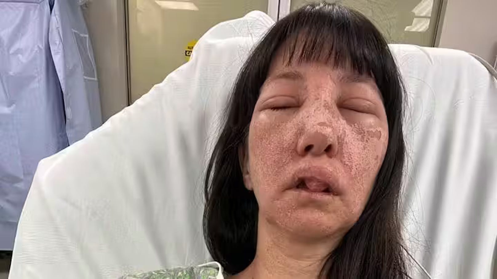 Spinnen beißen Jessica (44) ins Gesicht: "Haut brannte"