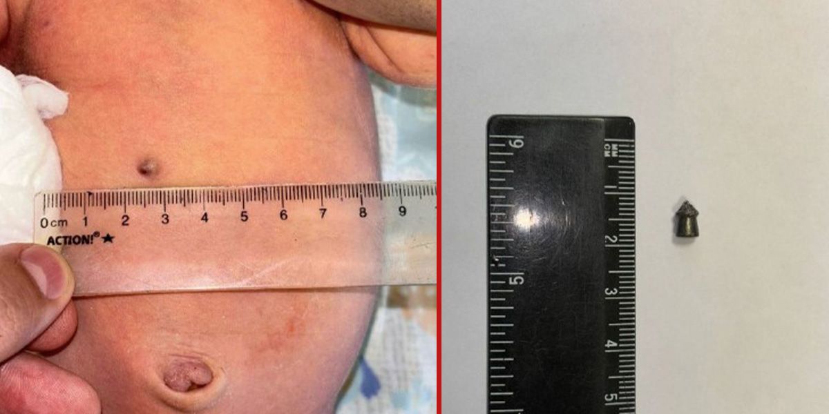 Das Geschoß drang durch den Bauch der Mutter bis in den Bauch des Kindes ein (siehe Bild).