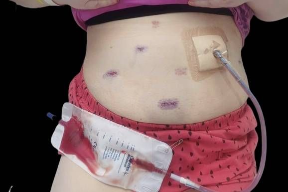 Innerhalb von 3 Monaten wäre die Britin zweimal fast an Komplikationen und einer Sepsis gestorben.