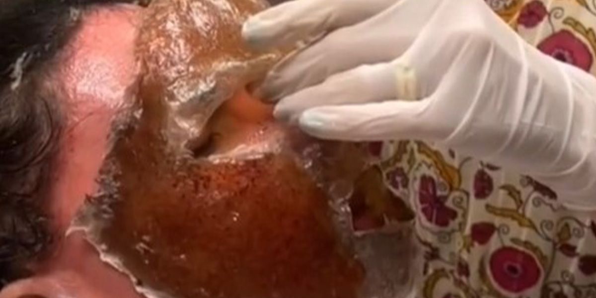 Das Phenolpeeling wird im Dämmerschlaf durchgeführt.