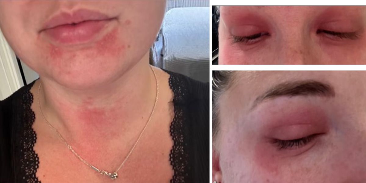 Georgina Jelley (Bild) zeigt ihre allergischen Reaktionen.