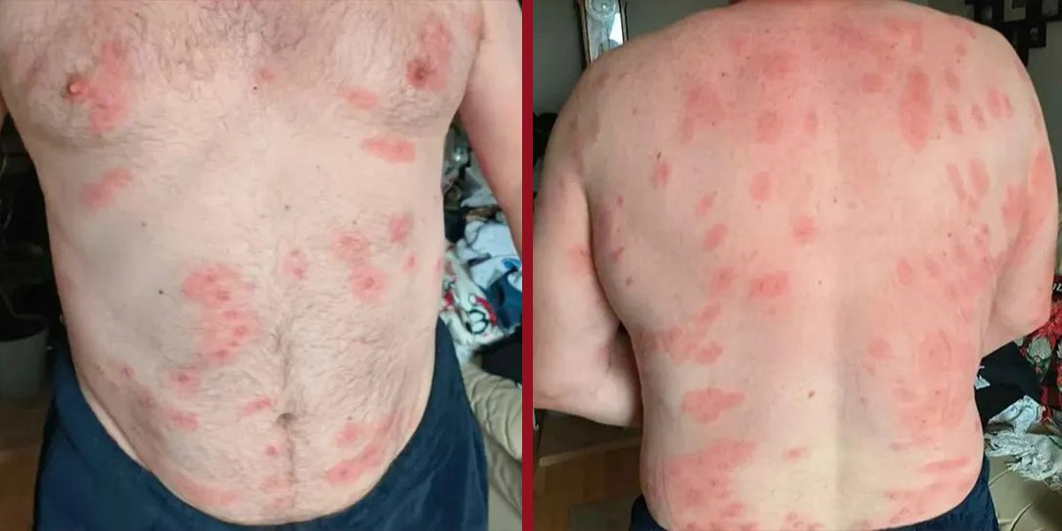 Andrew Powell nach der Wespenattacke.