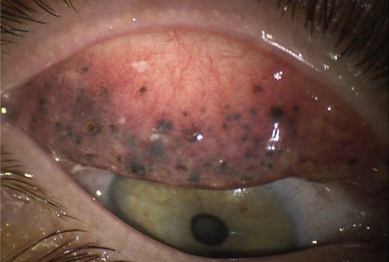 Bei einer Patientin hatten sich winzige harte Ablagerungen aus der Mascara gebildet, die nicht gründlich genug abgeschminkt worden war. Sie setzten sich in der Haut unter ihren Augenlidern fest.