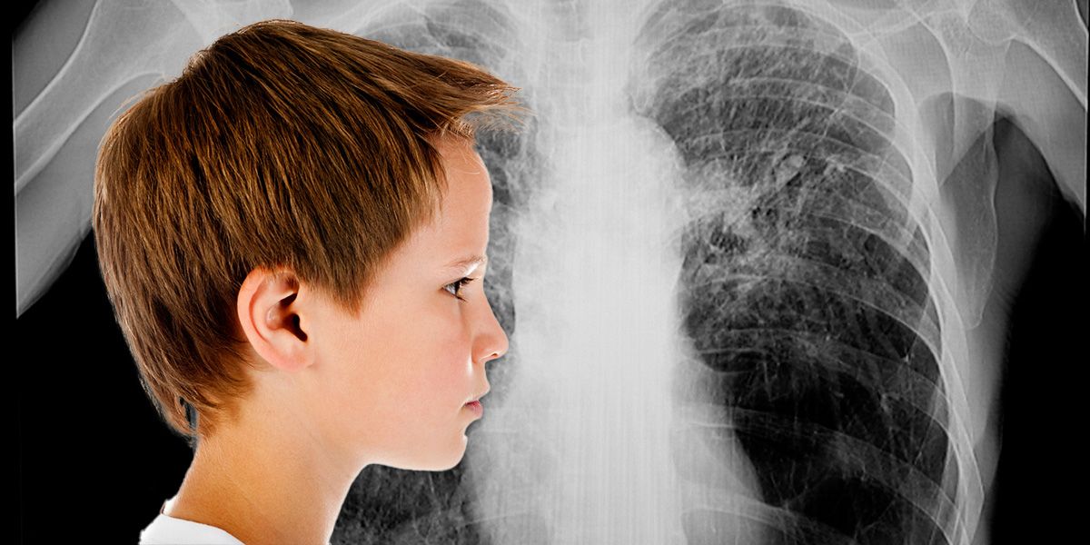 Weil die Lunge bis zum 25. Lebensjahr noch wächst, atmen Kinder mehr Luft und damit auch mehr Schadstoffe pro Kilogramm Körpergewicht ein.