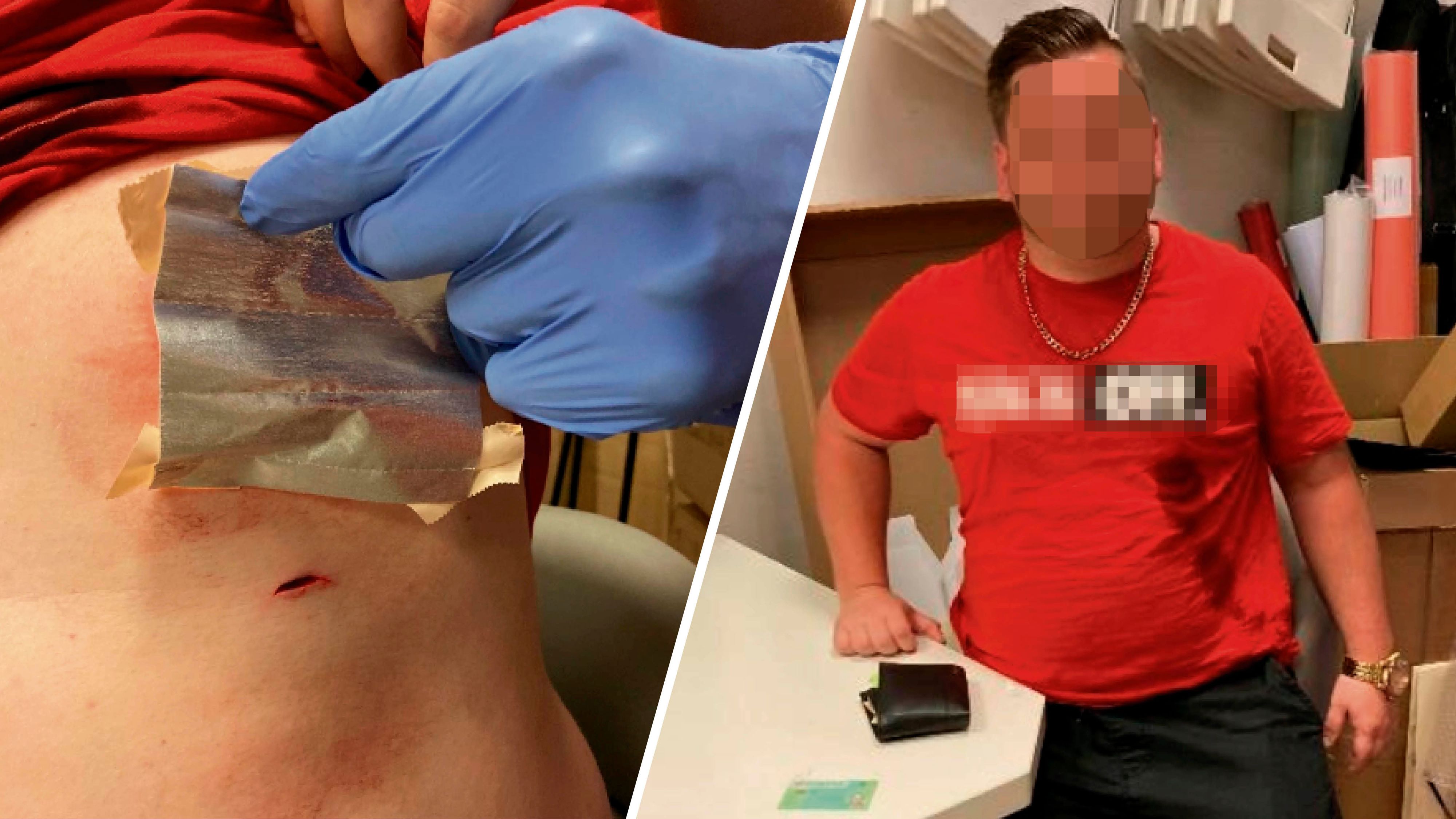 Ladendetektiv (26) wurde mit Messer attackiert; die Wunde nach dem Angriff (l.)