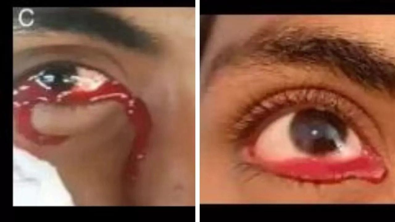 Der junge Bursche litt an einer seltenen angeborenen Gefäßanomalie, die bei ihm blutige Tränen verursachte (siehe Bild).