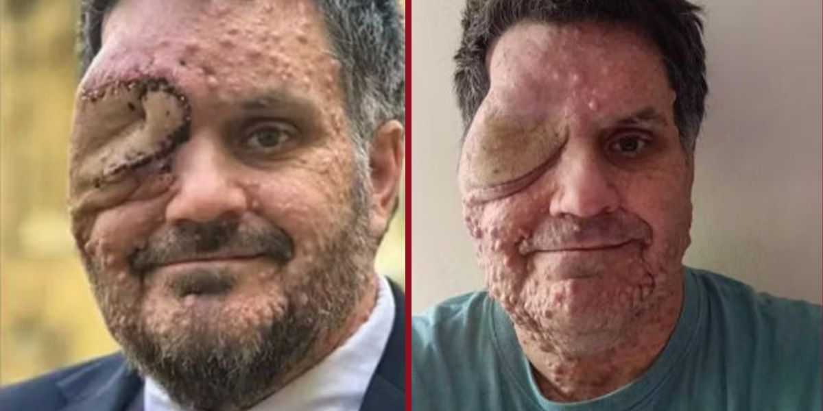 Oliver Bromley (Bild) verlor wegen der Erkrankung sogar ein Auge.