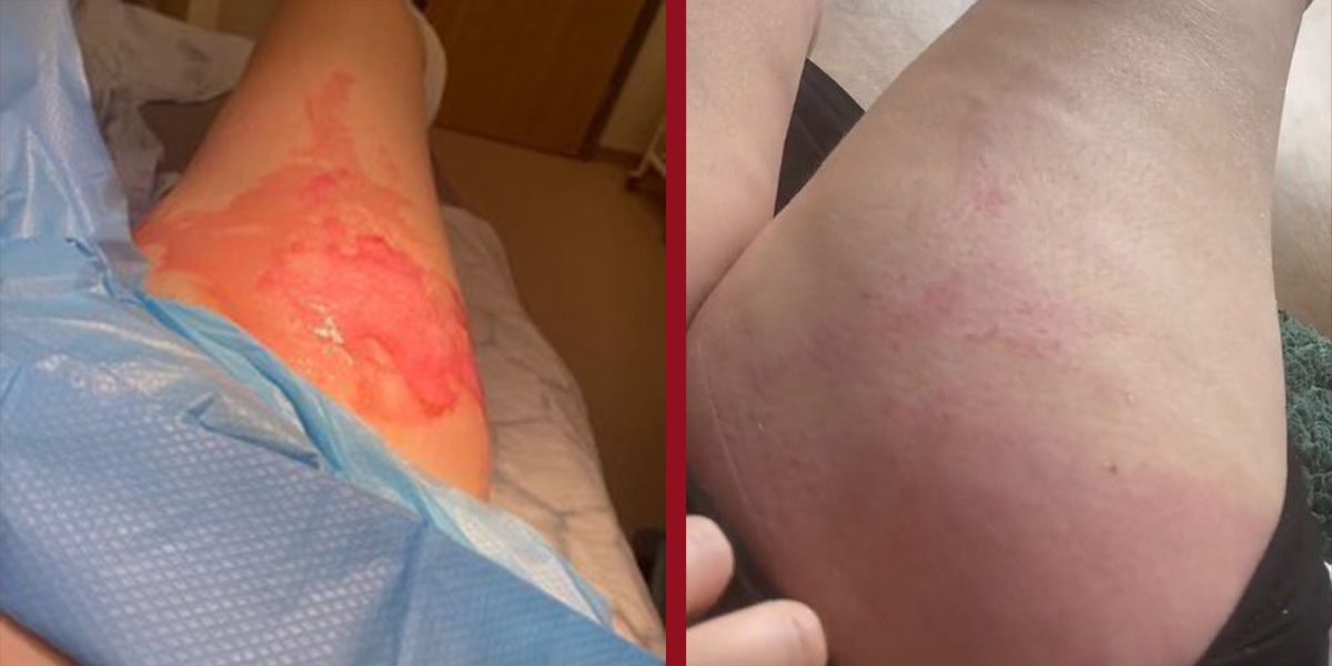 Yazmin Hardys verbrühter Oberschenkel kurz nach dem Unfall (li.) und 2 Wochen später (re.).