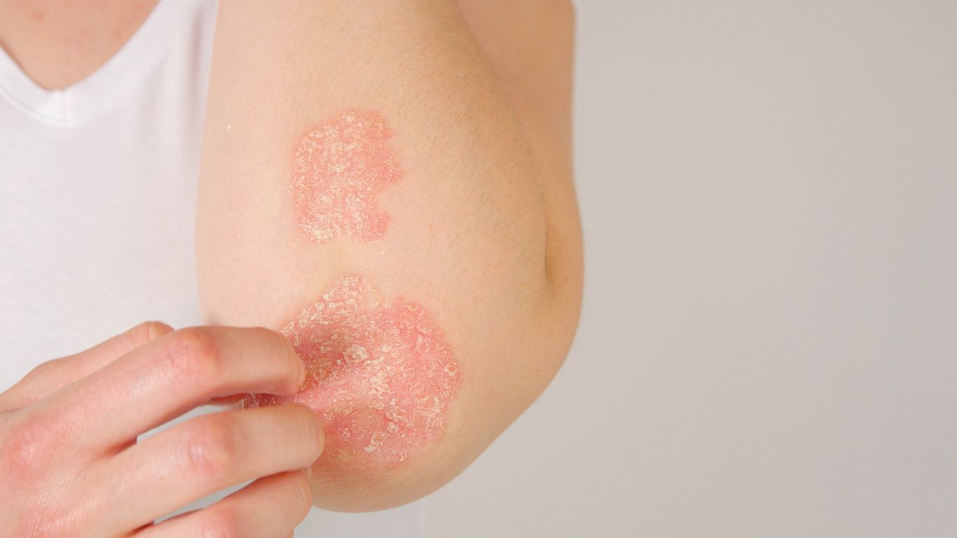 Schuppenflechte (Psoriasis) zeigt sich im Wesentlichen durch stark schuppende, gerötete Hautstellen.