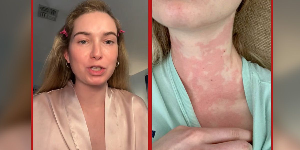 Caroline Cray Quinn (Bild) leidet am Mastzellen-Aktivierungssyndrom (MCAS), einer seltenen Erkrankung, die nur bei etwa einem von 150.000 Menschen auftritt.