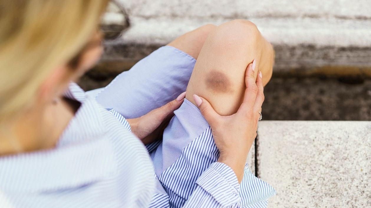 Bruised leg of a young woman, selective focus