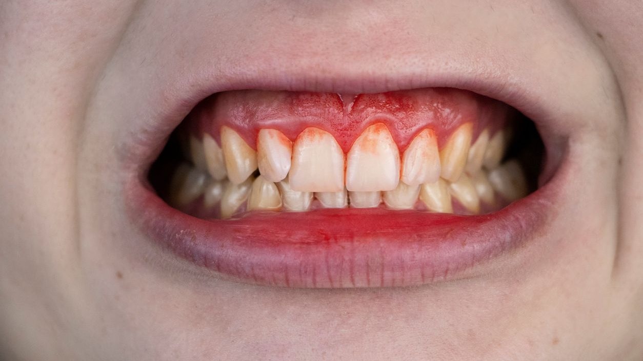 A man examined by a dentist. The diagnosis of gingivitis. Gum bleeding and inflammation close up.