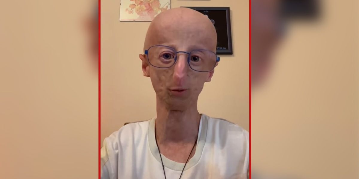 Durchschnittlich sterben Progerie-Betroffene bereits im Alter von 14 bis 15 Jahren. Sammy Basso war mit 28 Jahren die Ausnahme von der Regel.