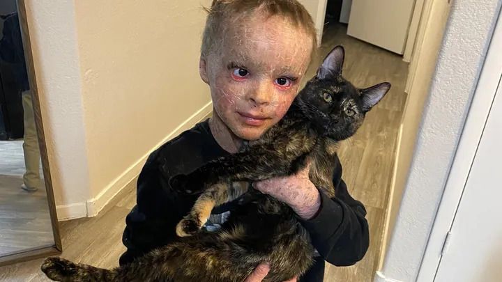 Carter (Bild) wurde mit der seltenen Krankheit Lamelläre Ichthyose geboren.