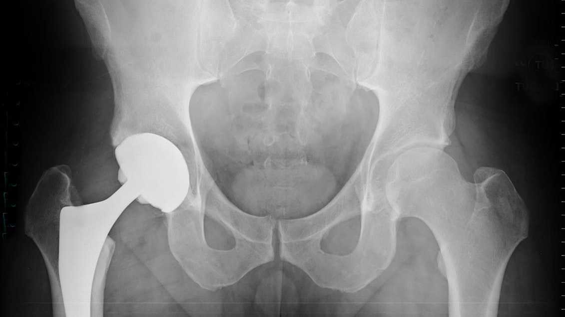 pelvis xray