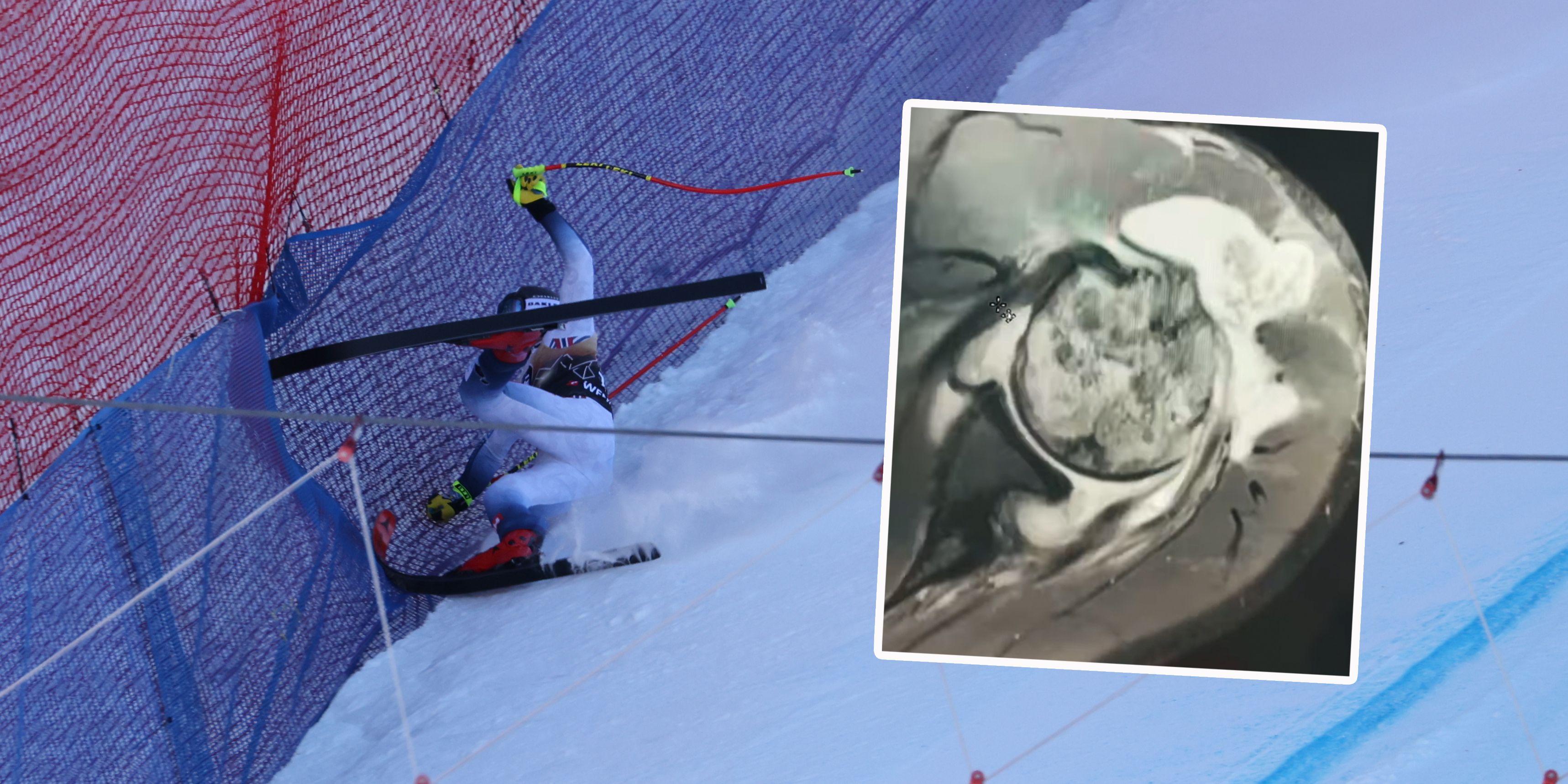 Aleks Kilde verletzte sich schwer an der Schulter. Eine Infektion in der Schulter fraß sich bis in den Knochen.