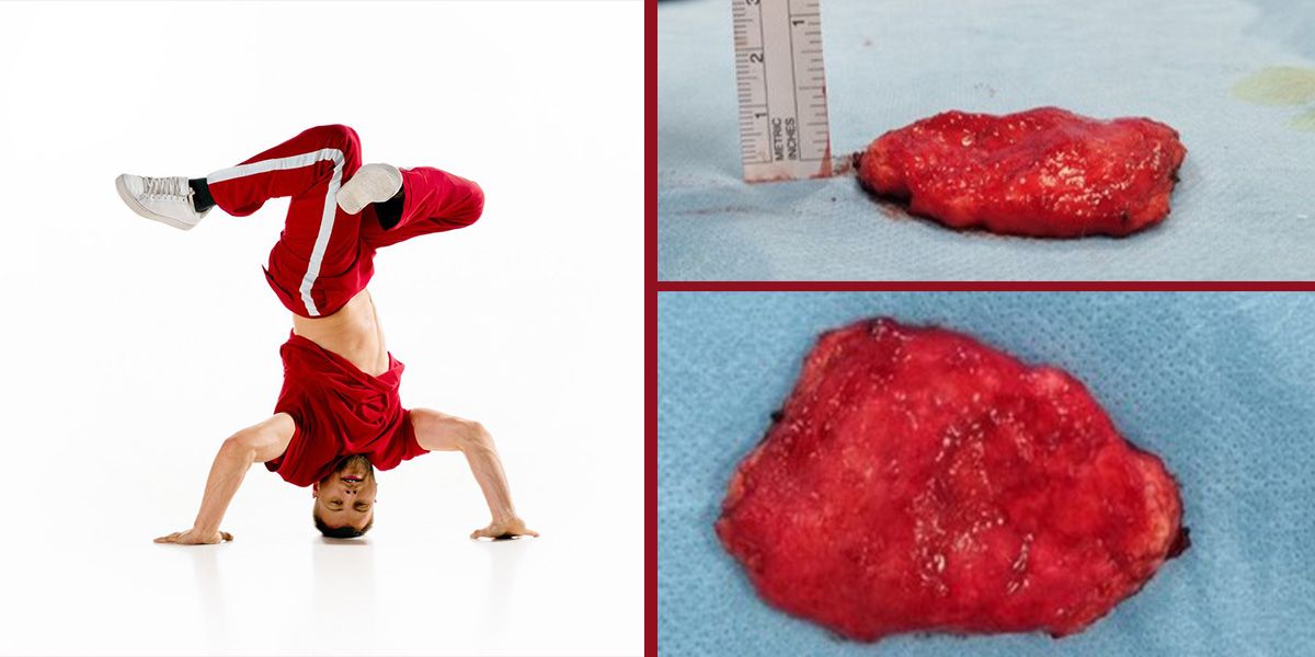 Dem Mann wurde eine 33,4 × 0,6 × 2,9 cm fibröse Masse (Bild) vom Schädel entfernt.