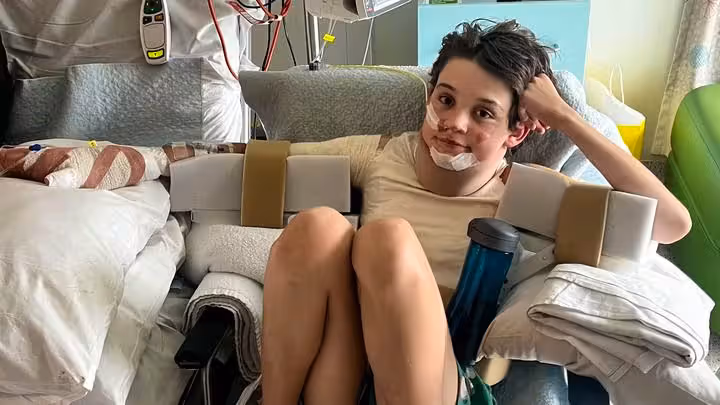 Levi erlitt schwere Verbrennungen, als sein Pulli in Flammen aufging. Seine Schwester reagierte blitzschnell und rettete ihm das Leben.