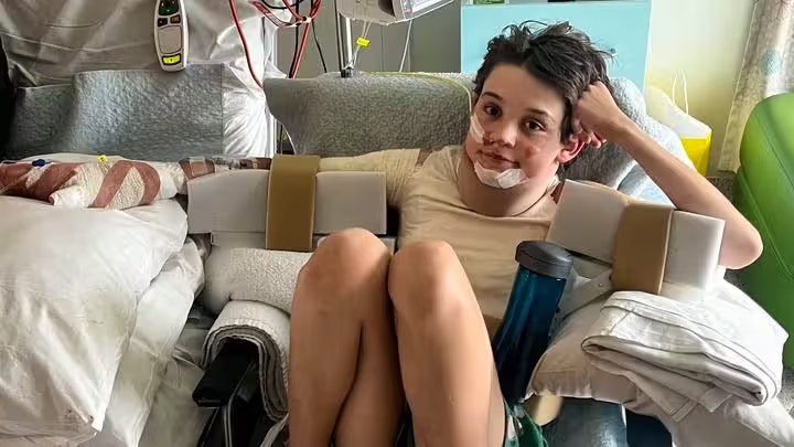 Levi erlitt schwere Verbrennungen, als sein Polyesterpullover in Flammen aufging. Seine Schwester reagierte blitzschnell und rettete ihm das Leben.