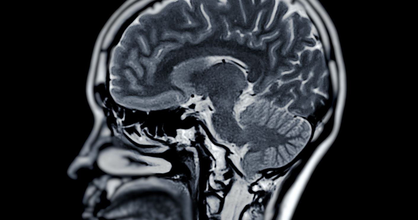 Im schlimmsten Fall kann ein Schlaganfall tödlich enden.