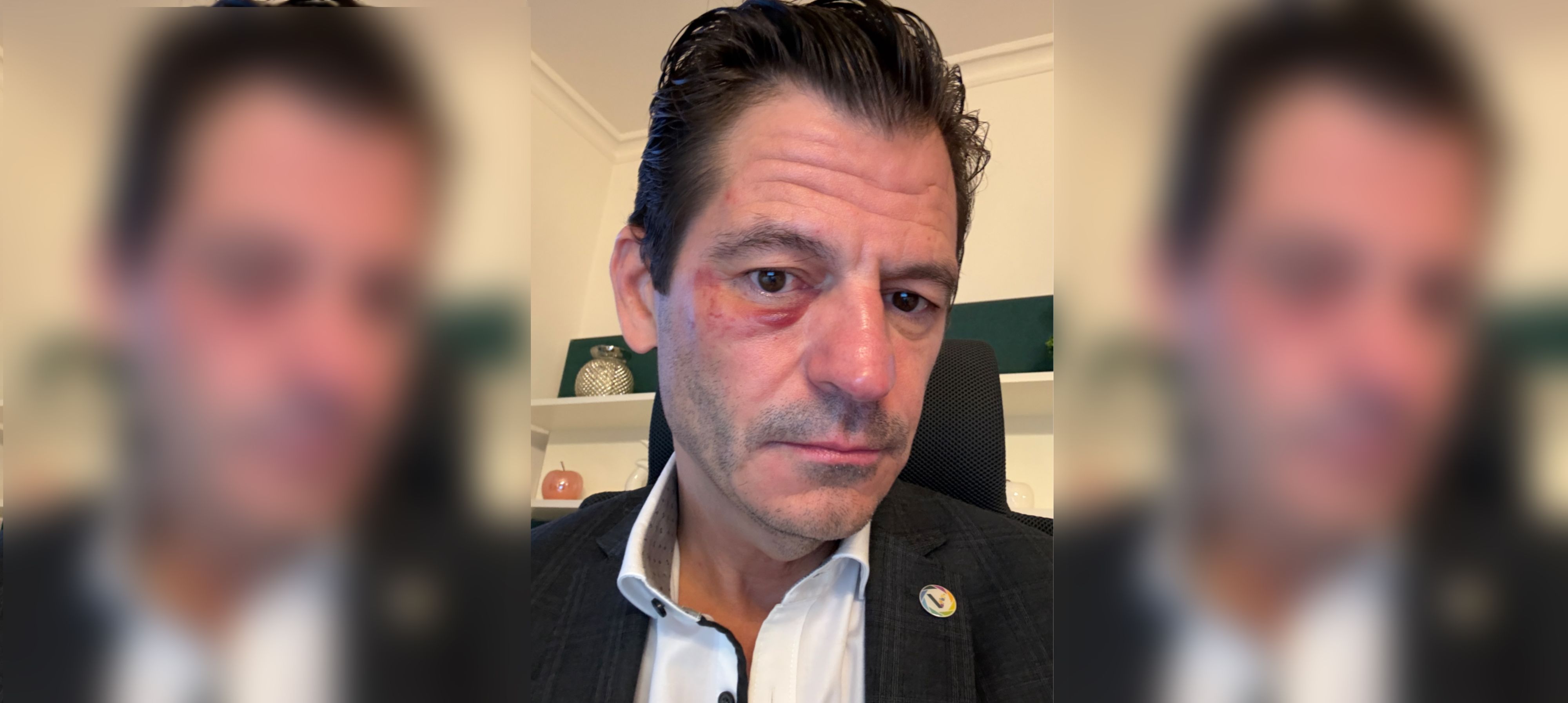 Mit einem ordentlichen blauen Auge: Bürgermeister Koza zeigt die Folgen des brutalen Angriffs im Schlosspark.