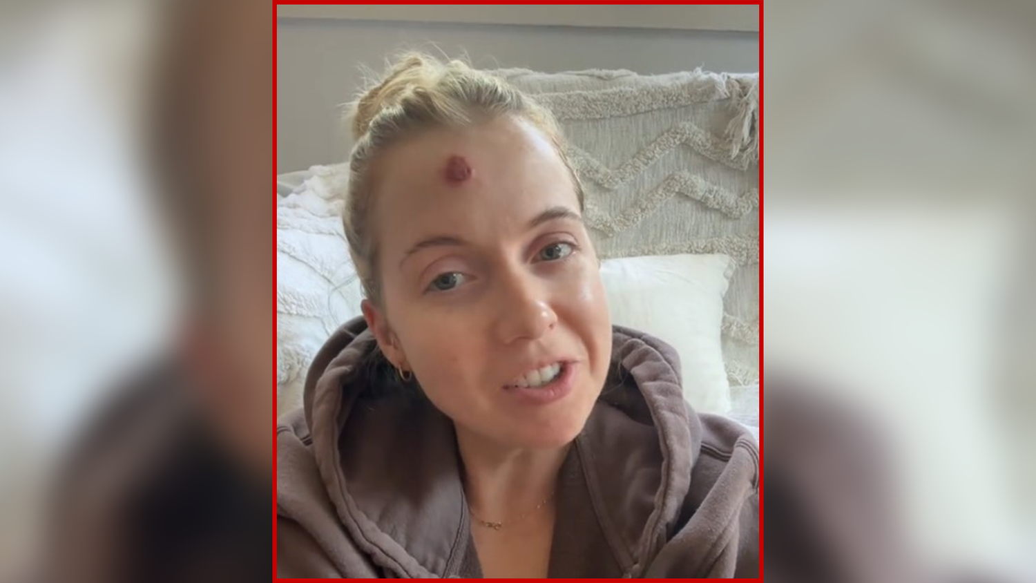 Ein vermeintlich harmloser Pickel stellte das Leben der australischen Influencerin Rachel Olivia (Bild) auf den Kopf.