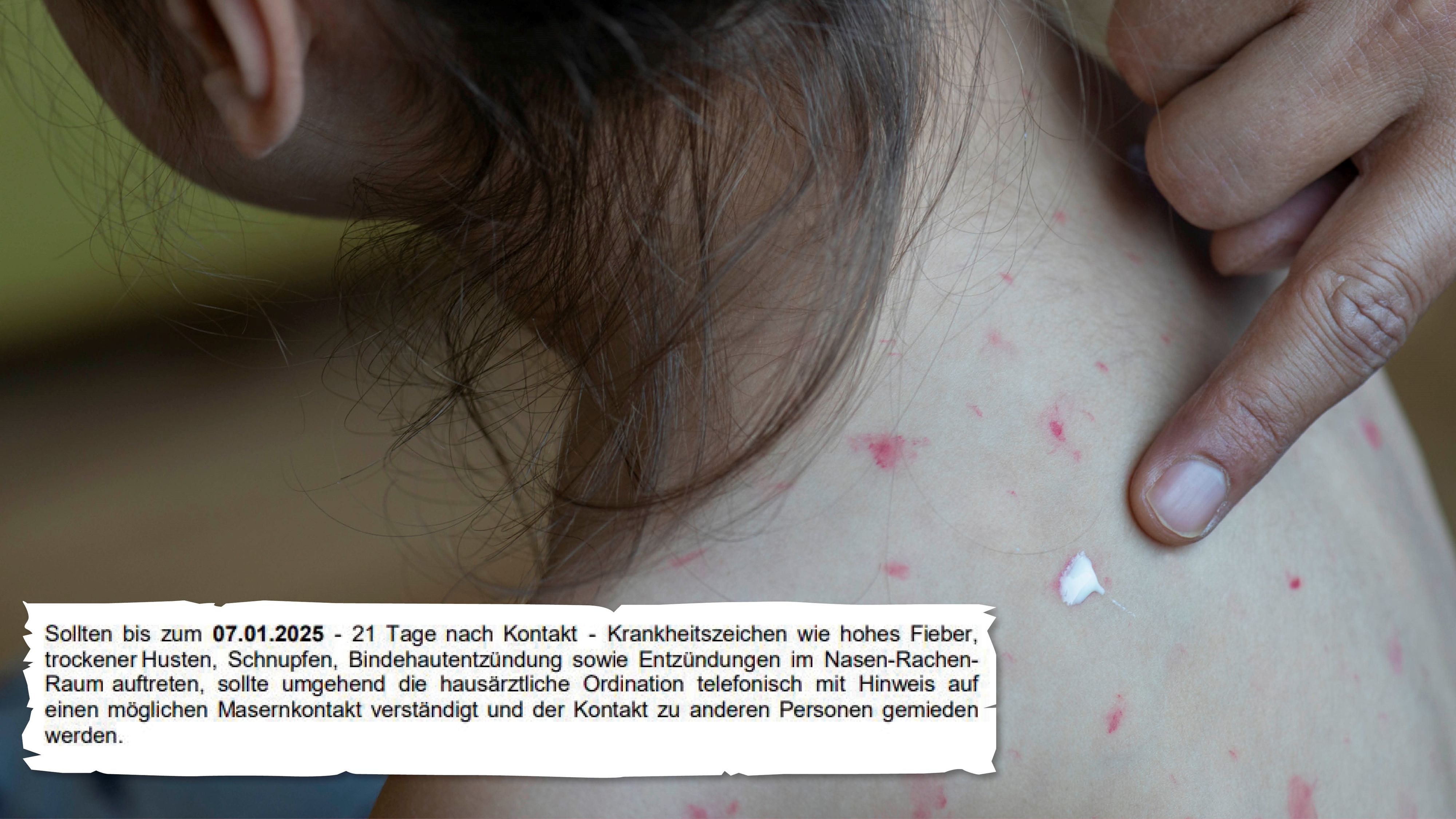 In Oberösterreich warnt die Bezirkshauptmannschaft Wels vor Masern.