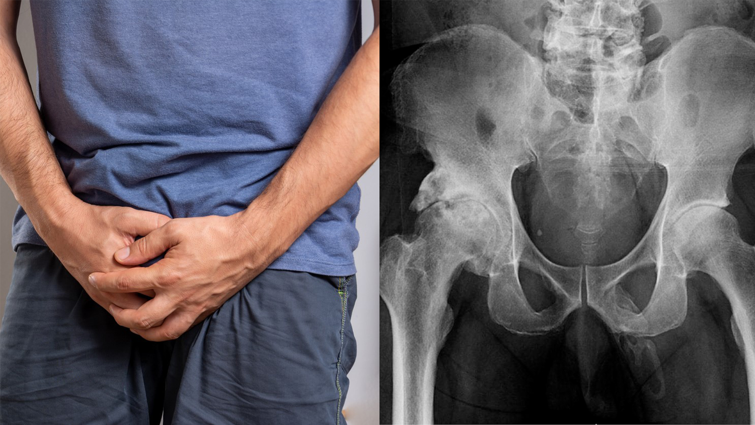 Warum sich der Penis des Mannes verknöcherte, konnten die Ärzte nicht aufklären. (Symbolbild)