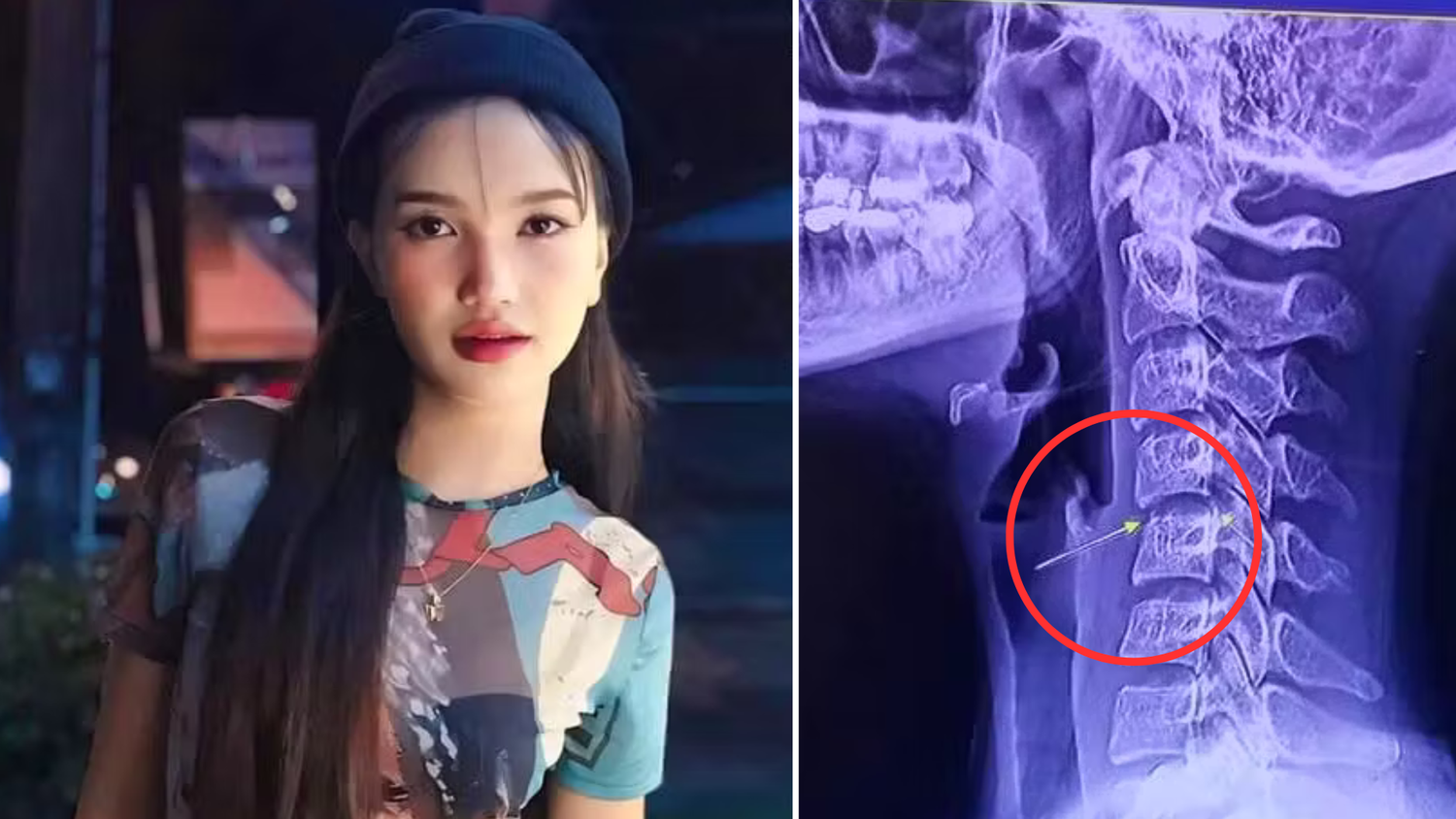 Die 20-jährige Chayada hatte drei sogenannte 