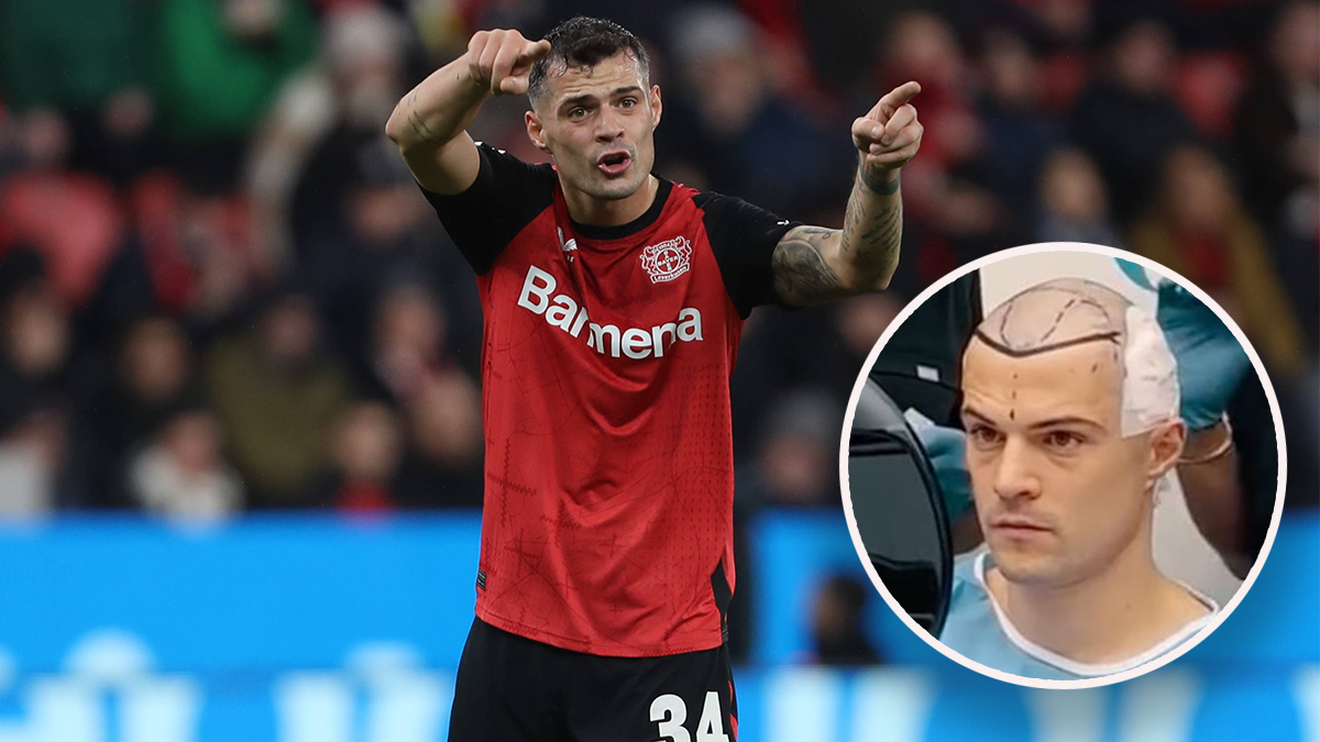 Granit Xhaka hat eine Haartransplantation im Kosovo machen lassen. 