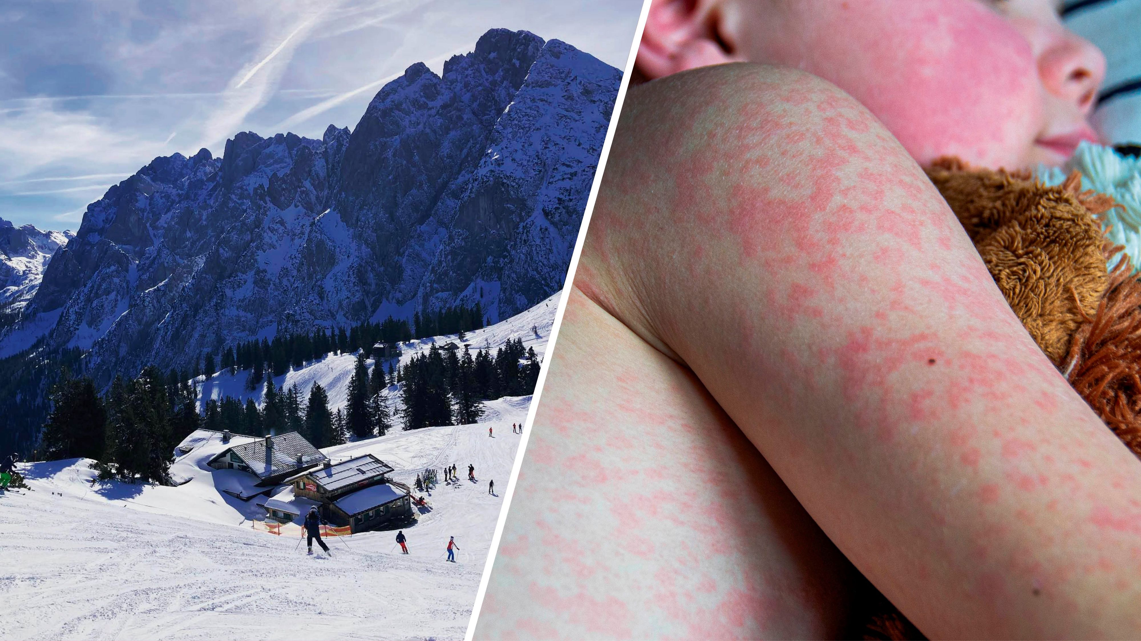 Die infizierte Person besuchte am 27. Dezember die Sonnenalm im Skigebiet Dachstein West.