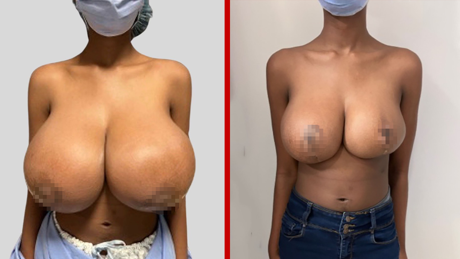 Die Patientin mit den gewachsenen Brüsten in Triple-G (li.) und nach der Brustreduktions-OP auf Doppel-D (re.).