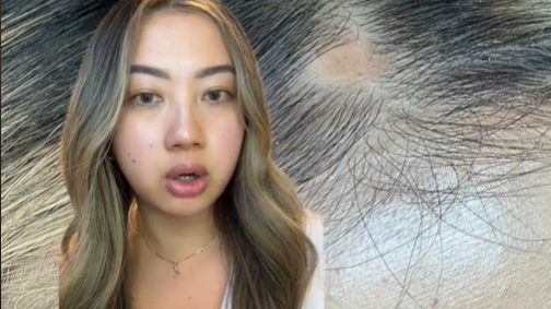 Hillary Nguyen (Archivbild): Die sportgegeisterte Frau steckte sich mit einer Pilzerkrankung an. 