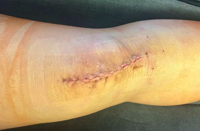 Jenal zeigt auf Instagram ihr operiertes Knie.