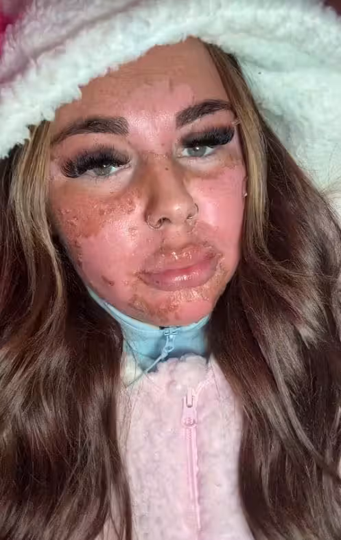 Die britische Influencerin Natalia Armstrong erlitt schwere Hautverbrennungen, nachdem sie sich falsch herum auf eine Sonnenbank gelegt hatte.